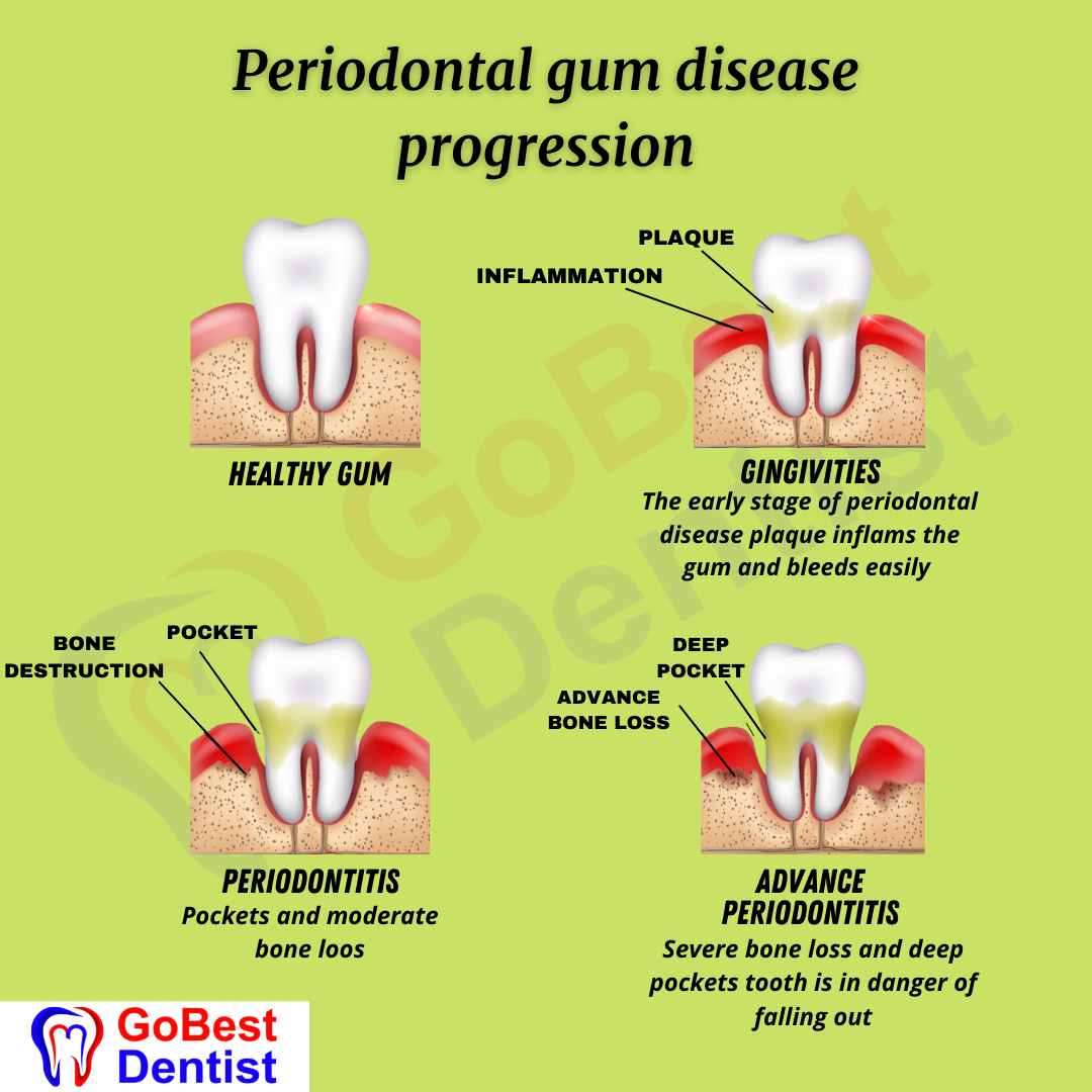 Flap Surgery & Gum Treatments