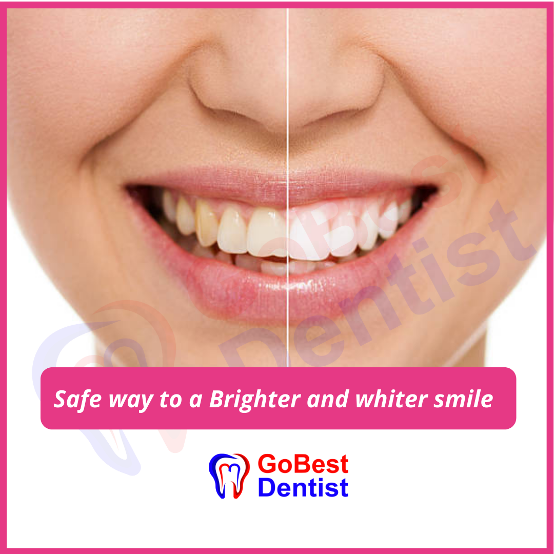 Teeth Whitening