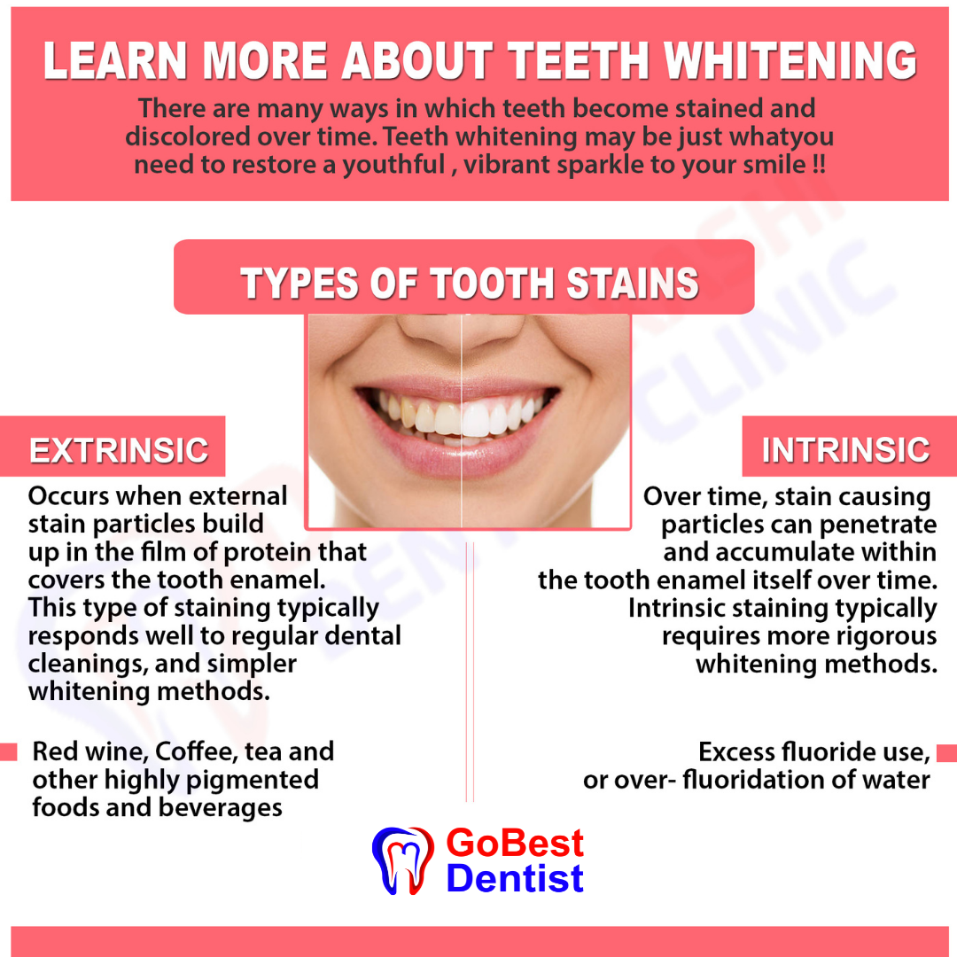 Teeth Whitening