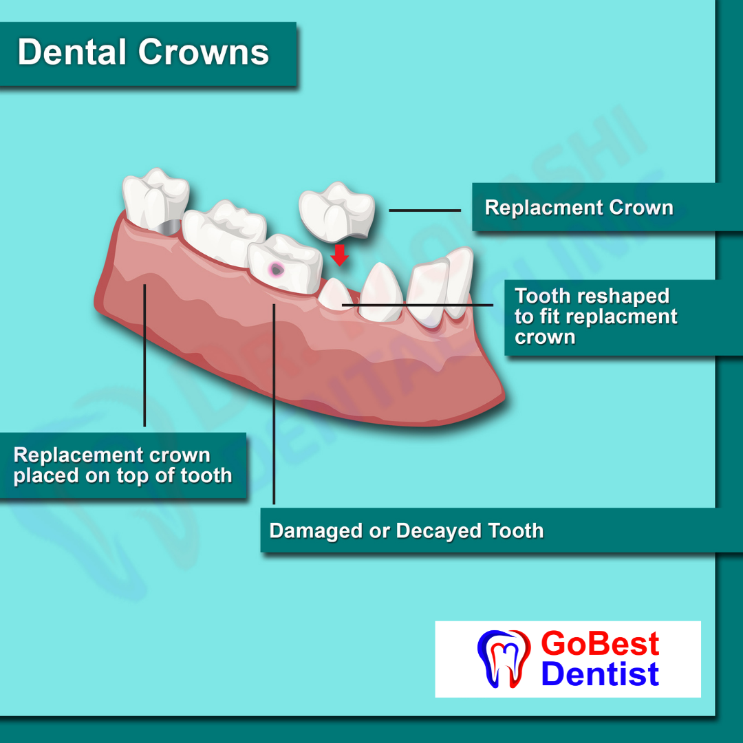 Dental Crown