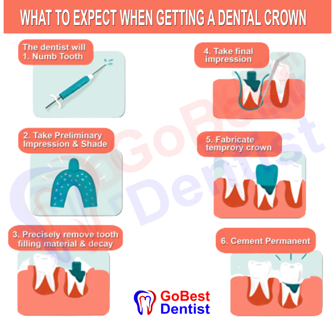 Dental Crown