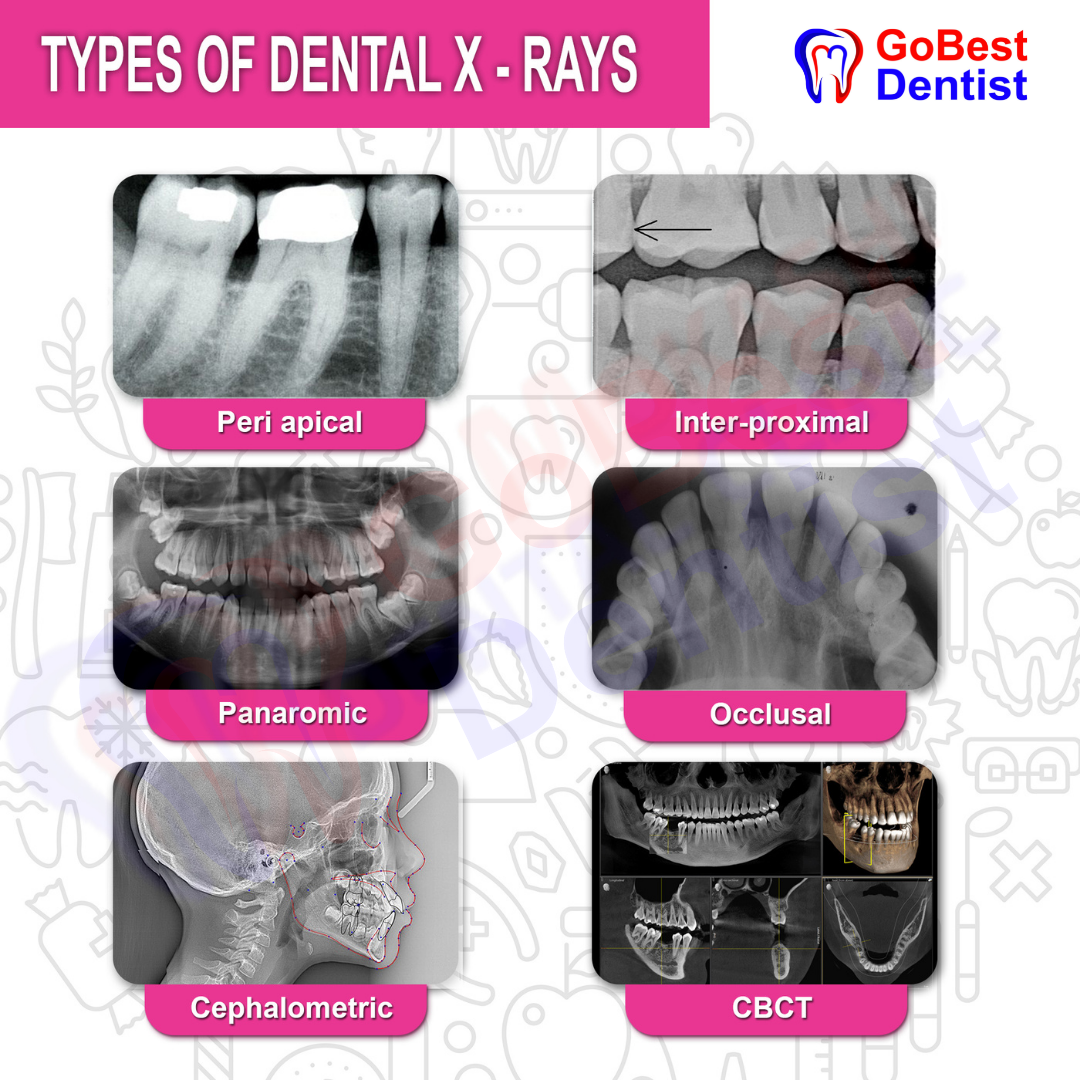 Dental X-Rays