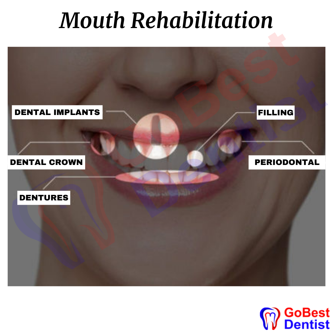 Full mouth rehabilitation surgery