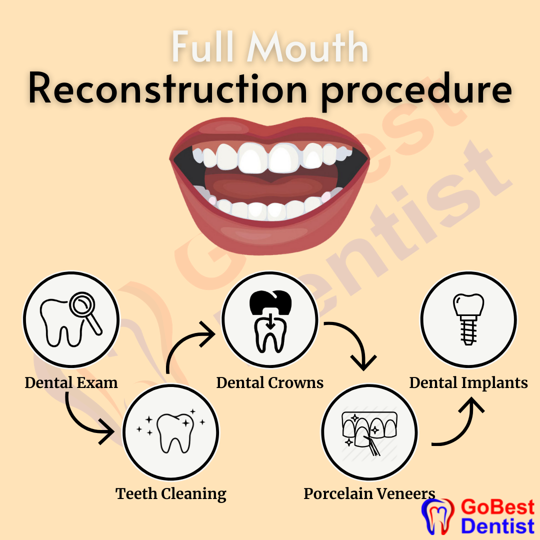 Full mouth rehabilitation surgery