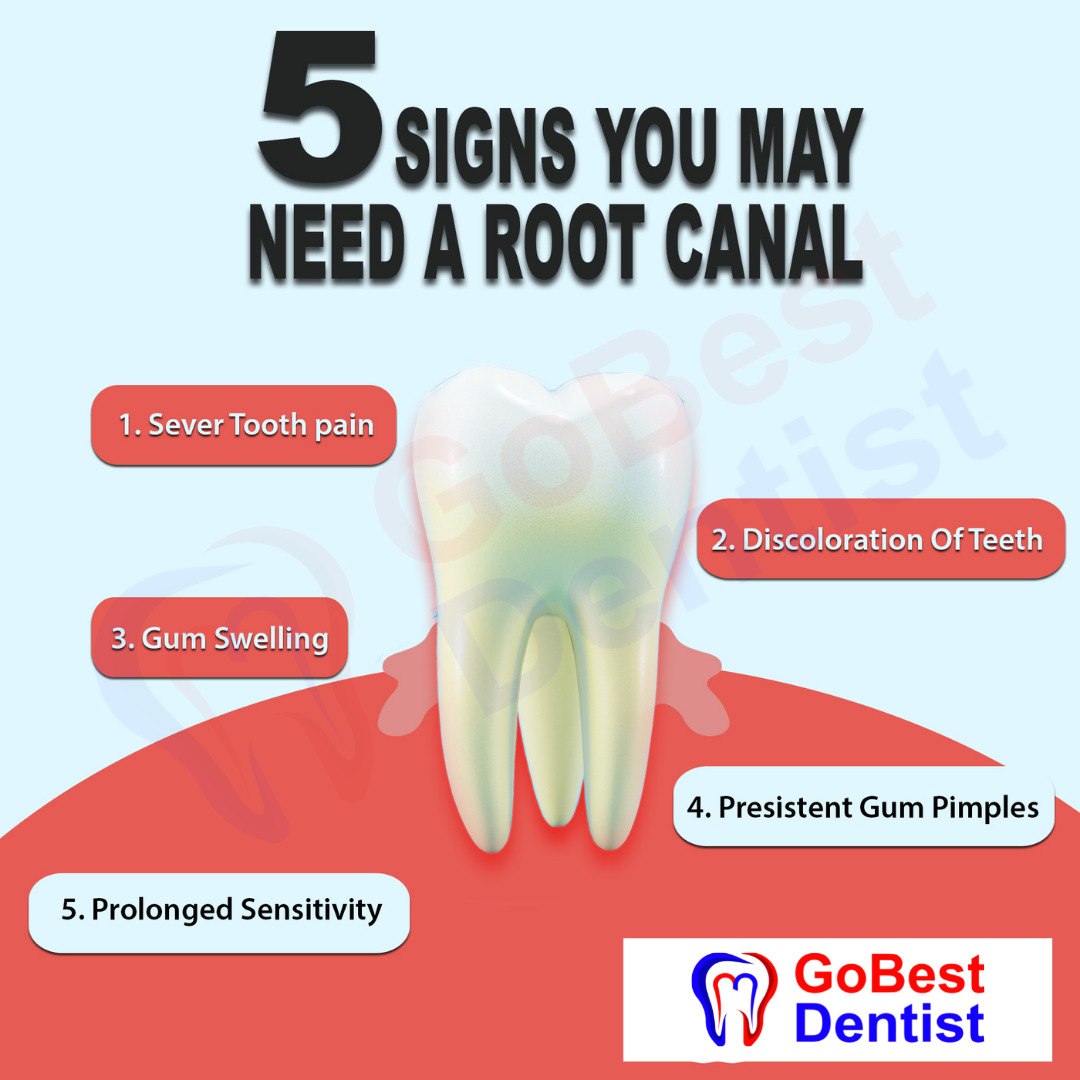 Root Canal