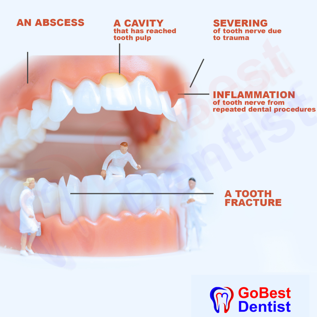 Root Canal