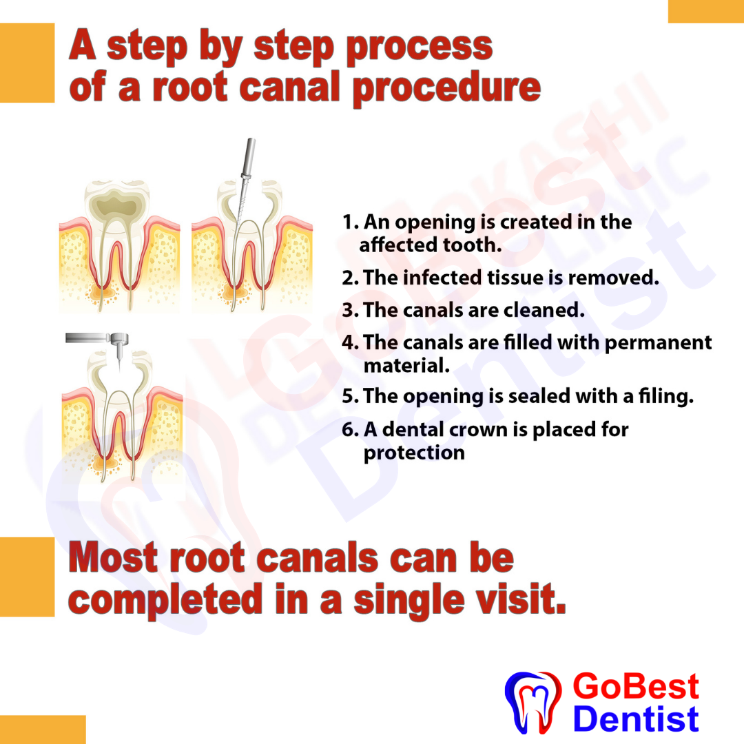 Root Canal