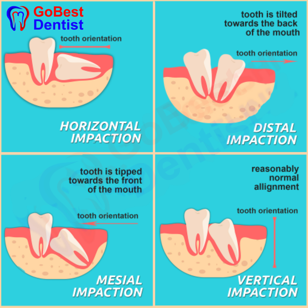 wisdom tooth